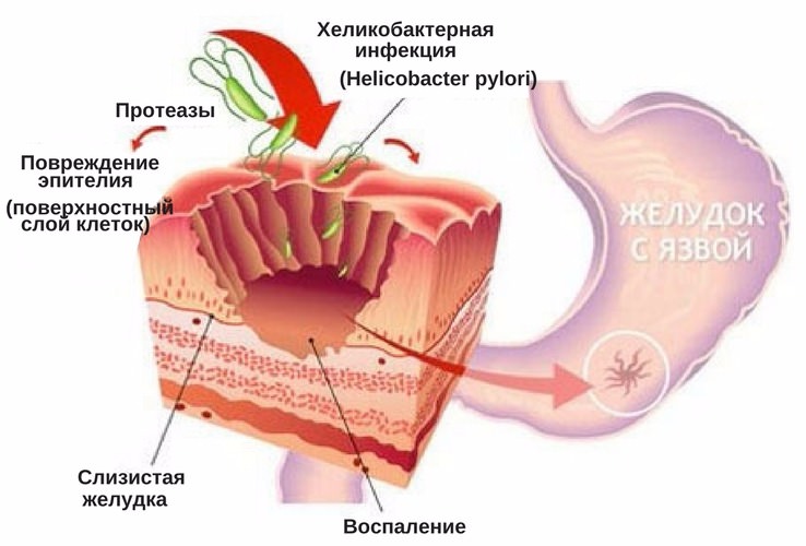 Почему болит желудок утром натощак Почему болит желудок утром натощак