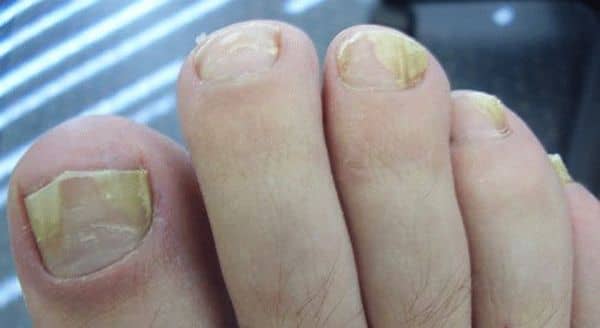 1 Причини жовтих нігтів на ногах