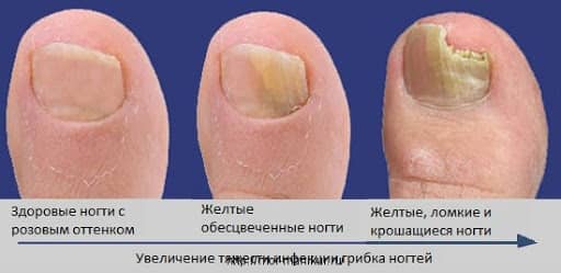 2 Причини жовтих нігтів на ногах